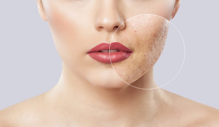 Acné : les bons gestes pour une peau zéro défaut